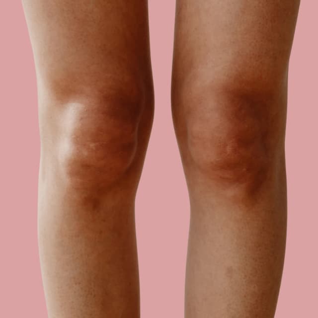 Zone 4: Knee CO2 Laser Skin Resurfacing